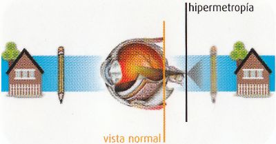 Esquema de ojo con hipermetropía